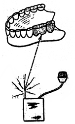 Figure 2 Signals can be transmitted' .from a radio to a receiver amplifier hidden in two false teeth, and then passed on to an adjoining viable tooth as in Figure 1. Drawing from US Patent 2 995 663 